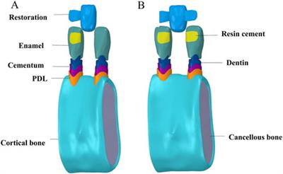 Biomechanical analysis of stress distribution and failure risk in mandibular incisors restored with resin-bonded fixed partial dentures using CAD/CAM materials and restoration designs